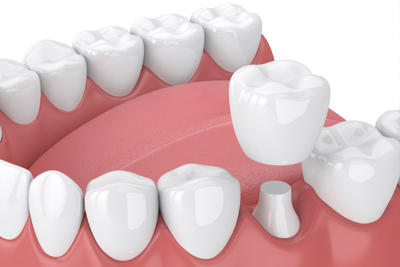 Dental Crowns in Statesboro