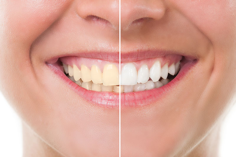 Teeth Whitening in Statesboro in Statesboro