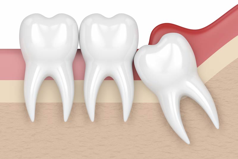 Wisdom Tooth Removal in Statesboro in Statesboro